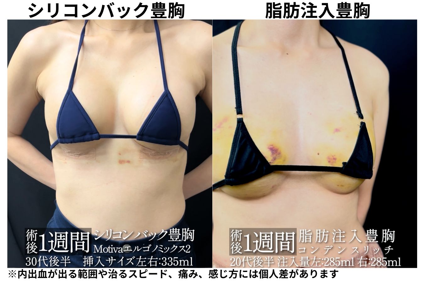 豊胸術の違いで痛みが変わる？